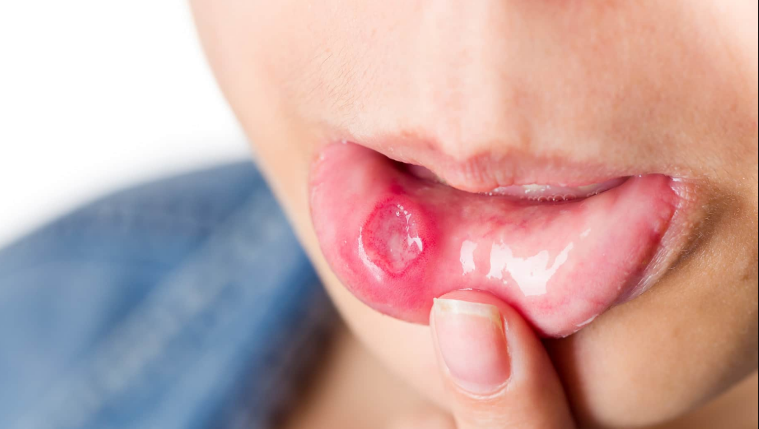 How Long Do Canker Sores Last? A Clear Guide to Healing Time how long do canker sores last